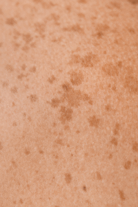 Hiperpigmentación post-acné