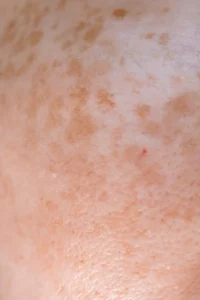 tratamiento nocturno para manchas