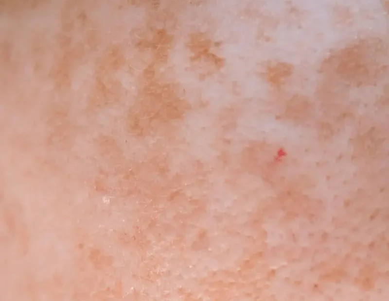 tratamiento nocturno para manchas