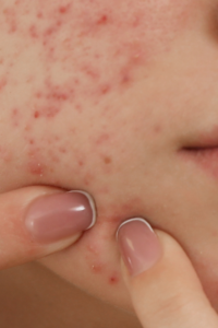 Cómo controlar el acné sin resecar la piel