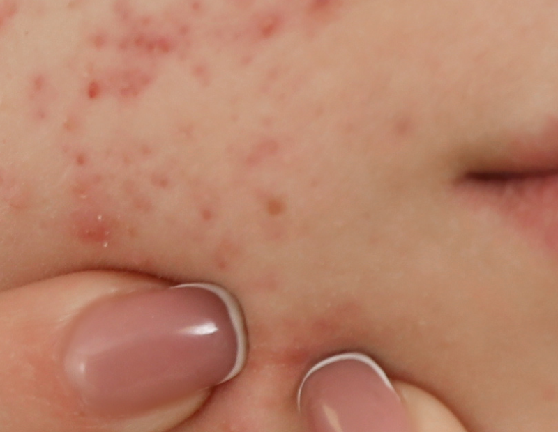 Cómo controlar el acné sin resecar la piel