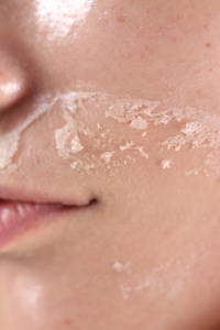 Resequedad de la piel en invierno