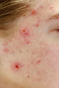 acné hormonal en mujeres