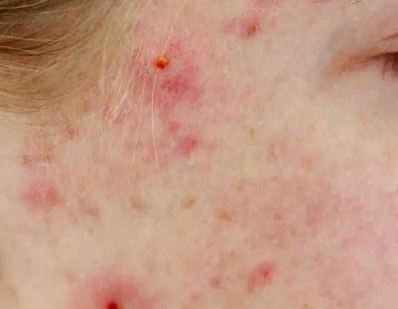 acné hormonal en mujeres